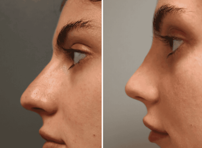 A profile shot of a patient showing the before and after of a rhinoplasty near Brentwood, TN